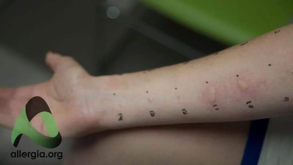 Example of skin prick test results — skin reactions to allergens