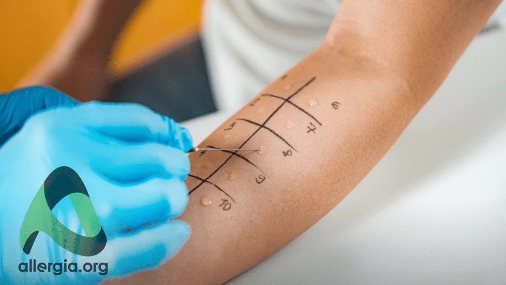 Skin prick test — a skin test for allergy diagnosis