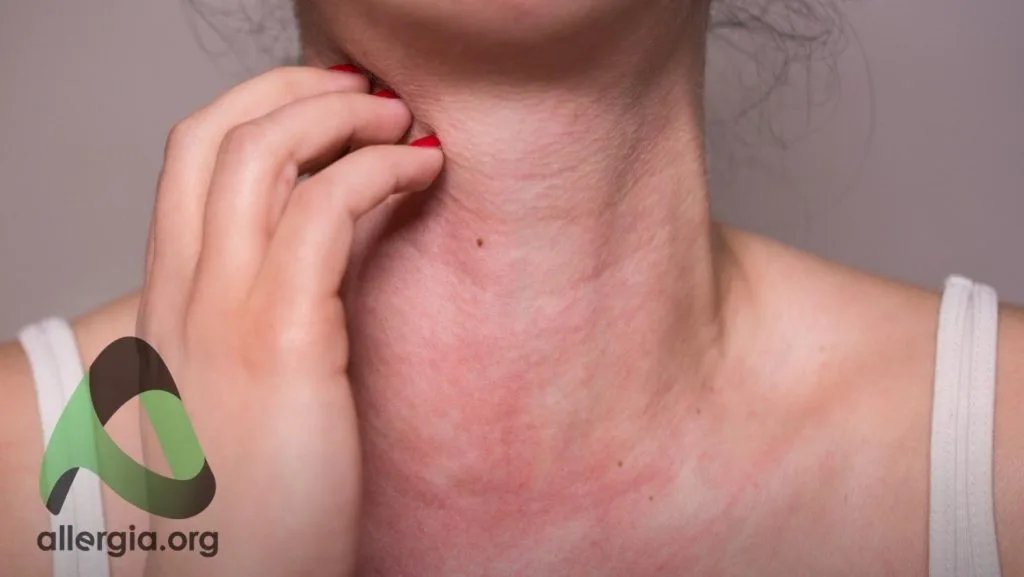 Allergy and psychosomatics — the effect of stress on allergic reactions