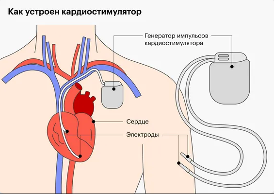 Как выбрать кардиостимулятор